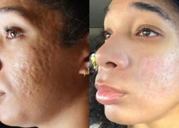How to Fade Pimple Scars Naturally and Restore Healthy Skin