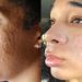 How to Fade Pimple Scars Naturally and Restore Healthy Skin