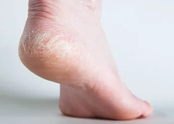 How to Remove Thick Dead Skin from Feet