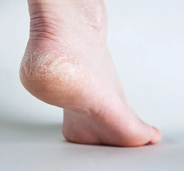 How to Remove Thick Dead Skin from Feet