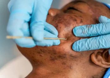 How to Remove Dark Spots Caused by Pimples