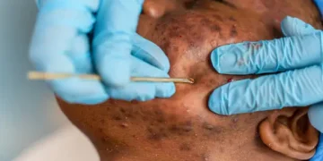 How to Remove Dark Spots Caused by Pimples