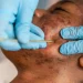 How to Remove Dark Spots Caused by Pimples