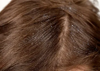 How to Avoid Dandruff in Hair Naturally
