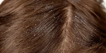 How to Avoid Dandruff in Hair Naturally