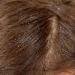 How to Avoid Dandruff in Hair Naturally