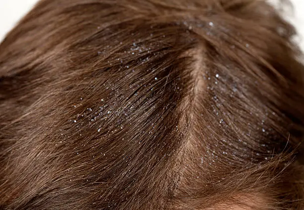 How to Avoid Dandruff in Hair Naturally