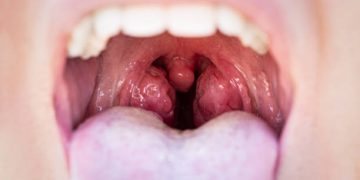 How to Avoid Tonsillitis in Kids